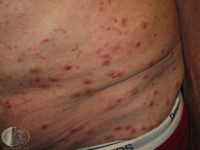 Fotoet viser skabbreaksjon