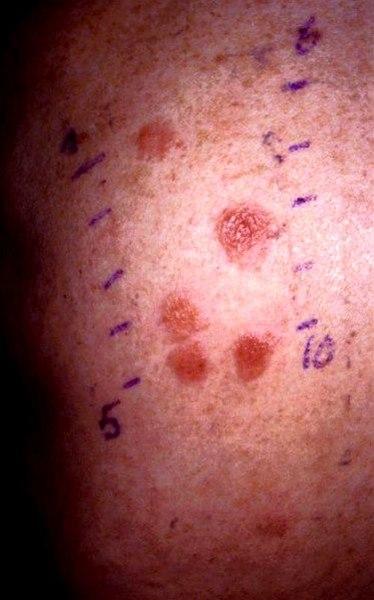 Positiv test for kontaktallergi mot enkelte planter. Papler og vesikler ved kraftig positiv reaksjon.