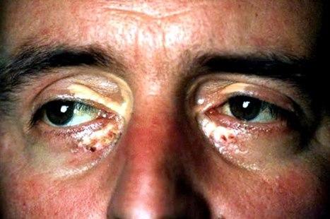 Xanthelasma