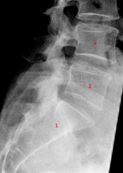 Lumbosacralcolumna, side