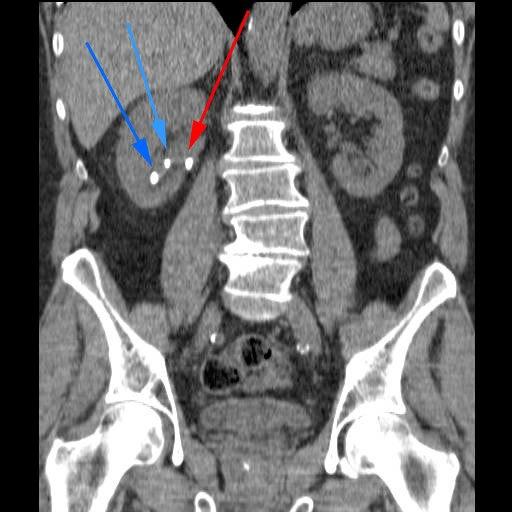 Nyresten påvist ved CT