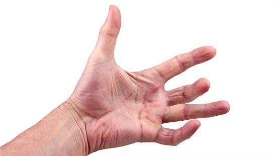 Illustrasjonsfoto av en hånd med håndkontraktur i 3. og 5. finger