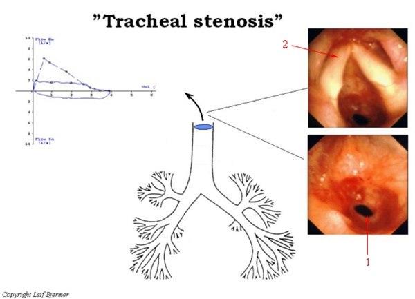 Trakeal stenose