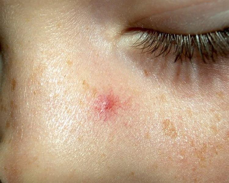 Fotoet viser nærbilde under øyet til et barn som har tegn til Stjernenævus