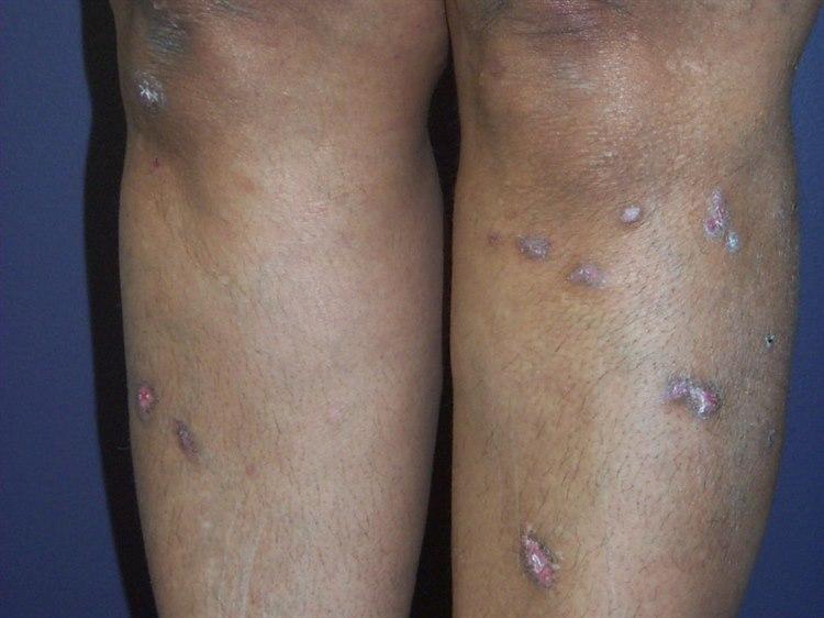 Lichen planus, hypertrofisk