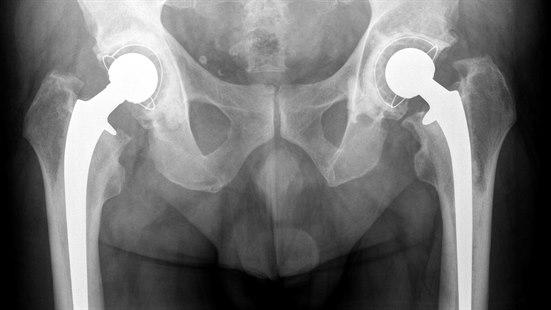 Fotoet vise er røntgenbilde av et menneskelig bekken der begge hofter er erstattet med totalproteser.