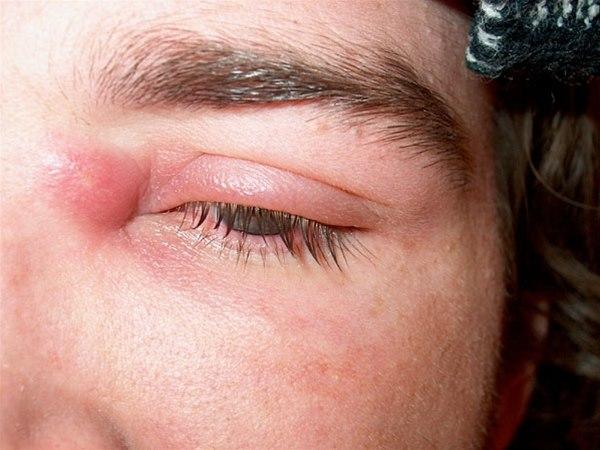 Lokal abscess med omgivende cellulitt.