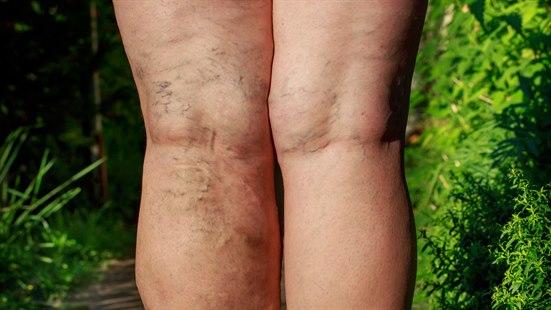 varicose veins
