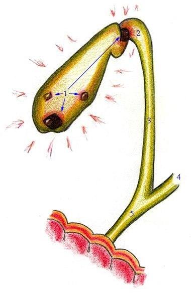 Galleblære - med stein