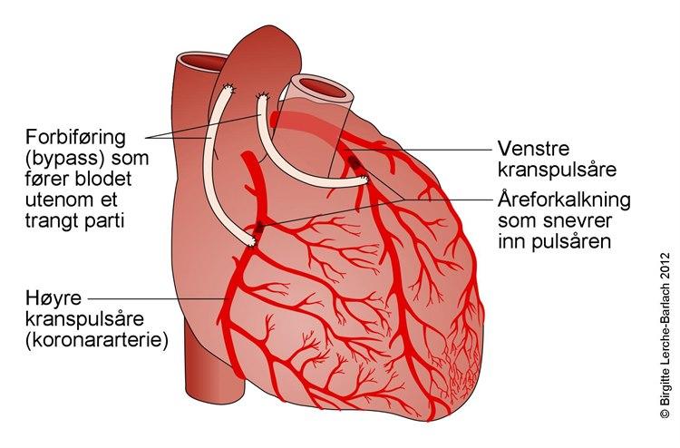 Koronar bypass
