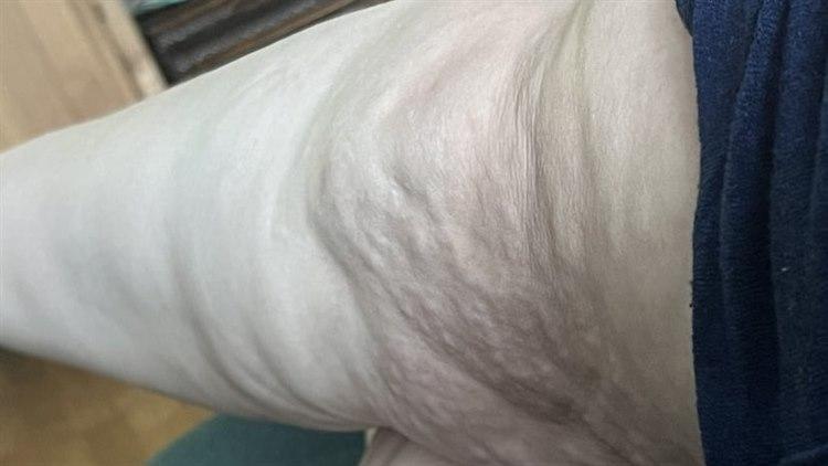 Foto av kne med lipødem