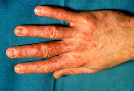Contact eczema, hand