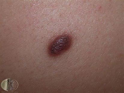 Fotoet viser nærbilde av et rødbrunt dermatofibrom