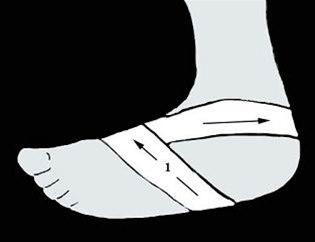 Fotsåleteiping bilde#1