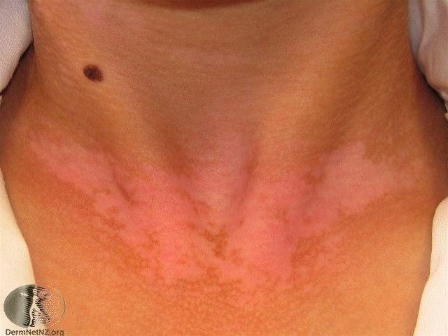 Fotoet viser vitiligo på hals