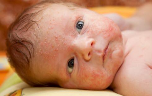 baby rash 