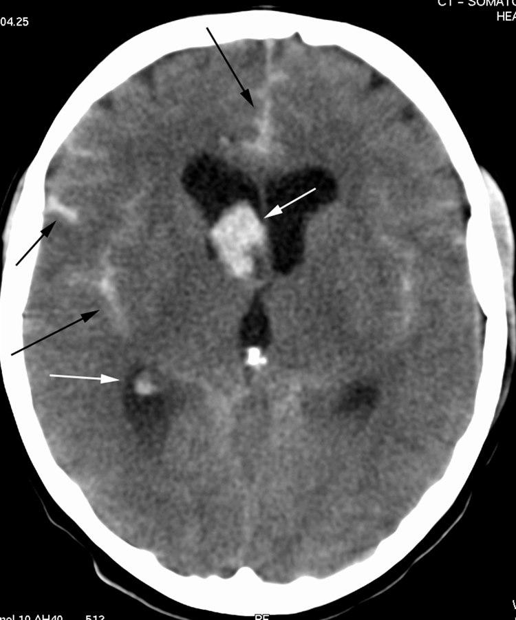 Subaraknoidalblødning (CT)