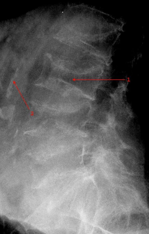 Osteoporose lumbalcolumna