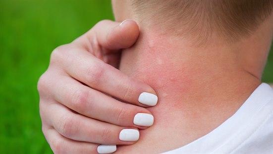 Myggstikk i nakken, hevelse