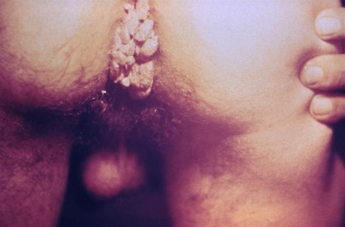 Kjønnsvorter. Foto: PHIL, CDC.