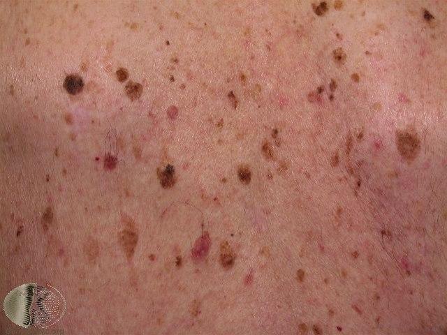 Fotoet viser seboroiske vorter på hud