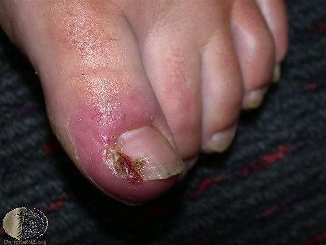 Fotoet viser inngrodd tånegl (betent)