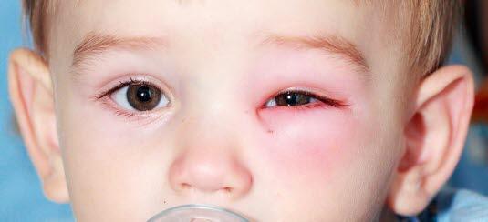 Nærbilde av et ansikt til et småbarn som har et rødt og hovent øye