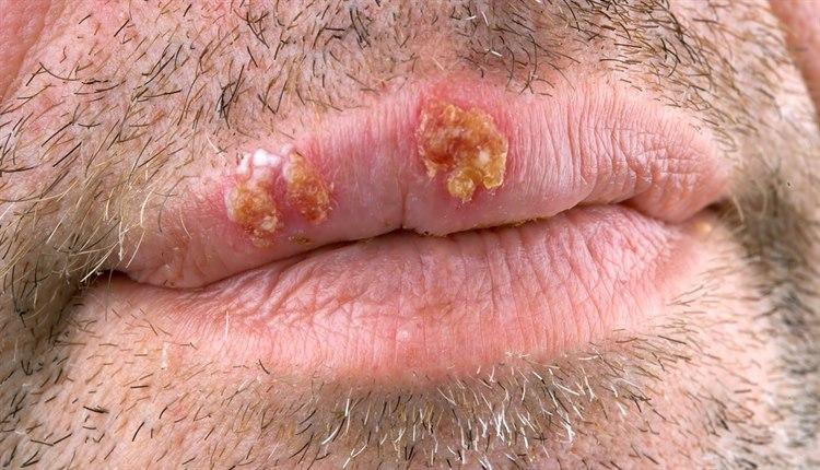 Fotoet viser herpes simplex 1 lesjon på leppe, mann