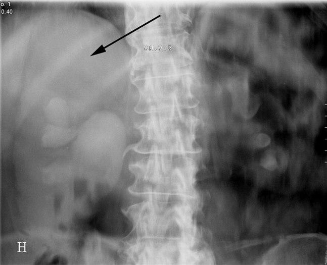 Nyrecyste (urografi)