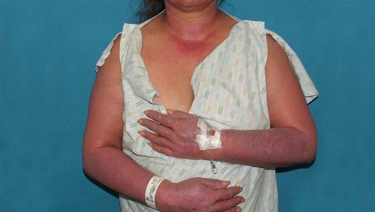 Medikamentelle eksantemer