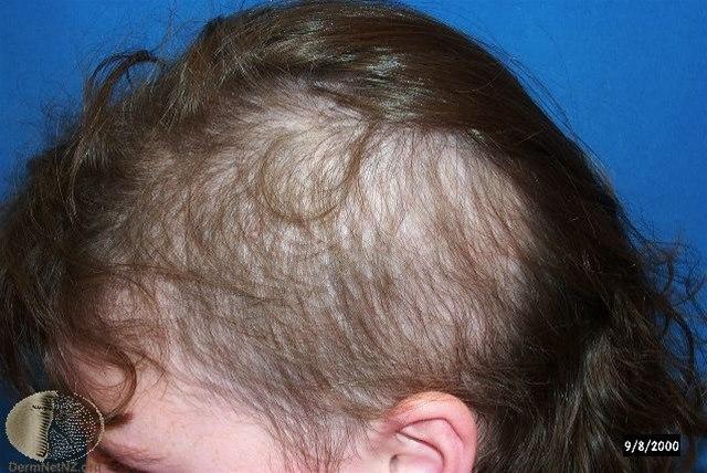 Fotoet viser trikotillomani