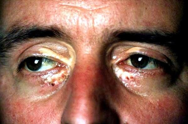 Fotoet viser utslett rundt øyeområde til en voksen mann