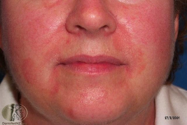 Fotoet viser seboroisk eksem, ansikt