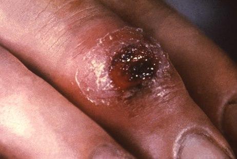 Ulcus durum, hand, primary syphilis