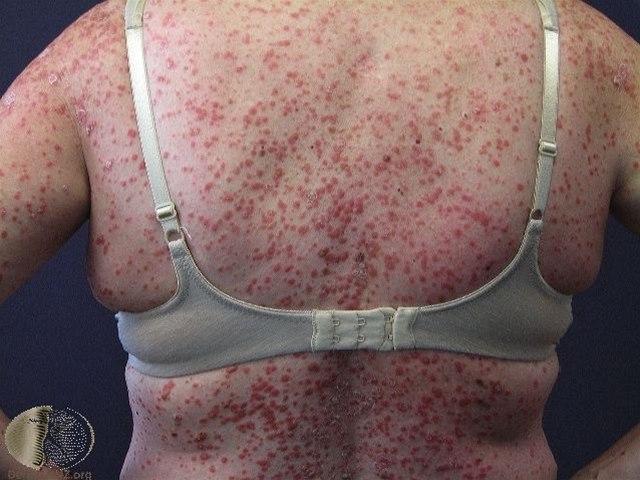 Fotoet viser psoriasis, guttat på ryggen til en kvinne