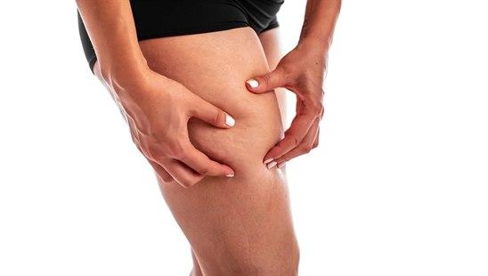 Bilde av kvinne som tar seg til utsiden av låret