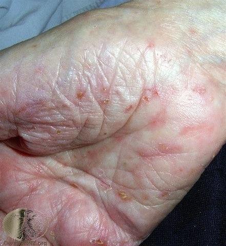 Fotoet viser skabb, palmare funn i håndflaten