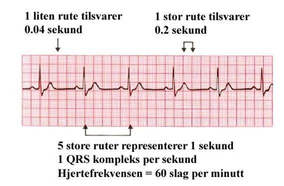 EKG hastighet
