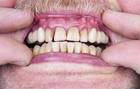 Gingivitis