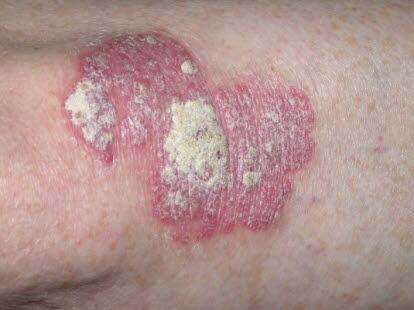Psoriasis, plakk