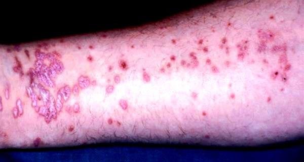 Sterkt kløende, symmetrisk utbredt exanthem med typisk lokalisasjon volart på underarmene. Rødviolette, velavgrensede papler og plaque med noe glinsende overflate.