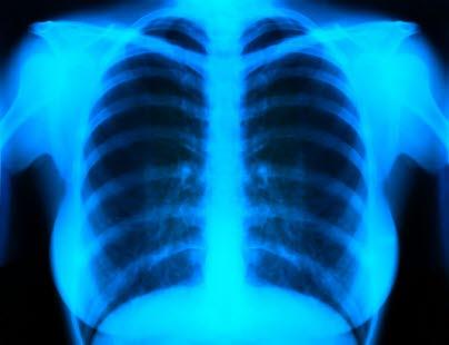 røntgenbilde av lungene