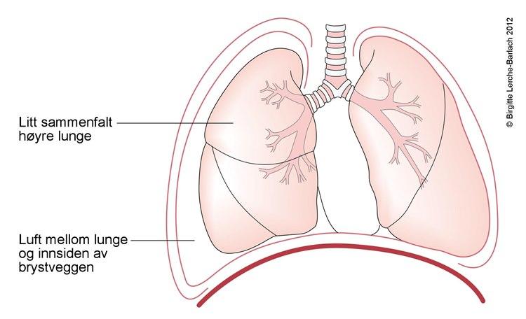 Total pneumothorax