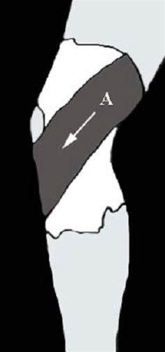 Kneleddsteiping bilde#4