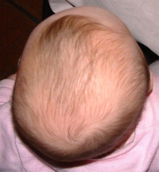 Baby med skjevt hode.