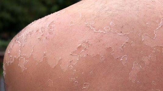 En solbrent skulder og huden har begynt å flasse av