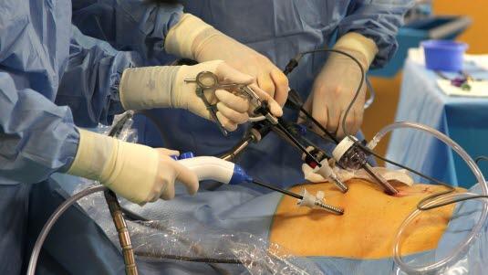 Laparoscopy