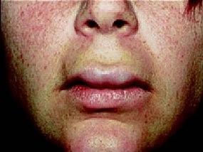 Angioødem i ansiktet og leppene med tydelig opphovning.