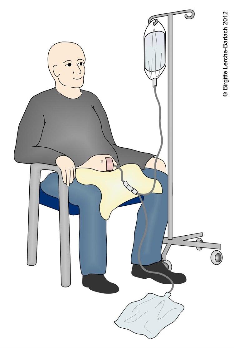 Tegning som viser mann sittende i stol med oppkoblet posedialyse.