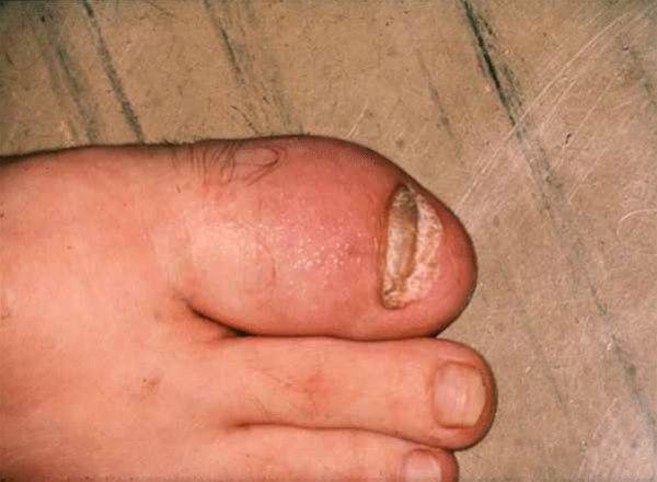 Arthritis psoriatica